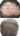 Before and after results showing improved hair density after using Moxi Loxi Growth Factors+ Peptide Hair Growth Serum for thinning hair.