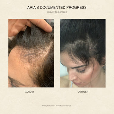 Side by side photographs of Aria's hairline and scalp in August and October during consistent use of the MOXI LOXI scalp care routine.