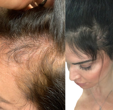 Woman with thinning hair showing scalp and hairline before and after using Moxi Loxi Growth Factors+ Peptide Hair Growth Serum